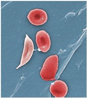 Secondary Infertility After C Section