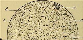 Infertility After Two Miscarriages