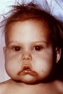 Infertility Treatment Gender