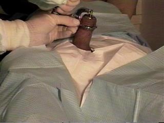 Infertility Treatment With Stem Cells