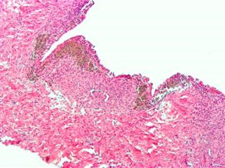 Infertility Abnormal Uterine Bleeding