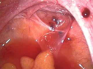 Female Infertility Causes Symptoms and Treatment