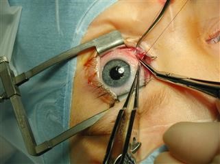Infertility Testicular Torsion