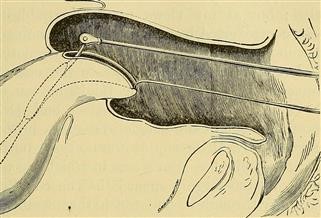 Who Infertility Disease