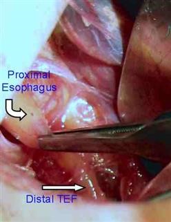 Pcos Infertility Mechanism