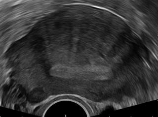Infertility Treatments Injections