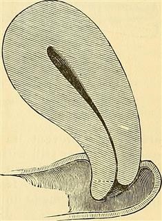 Infertility After Emergency C Section