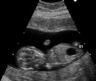 Primary Infertility and Varicocele