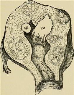 Saline Ultrasound Infertility