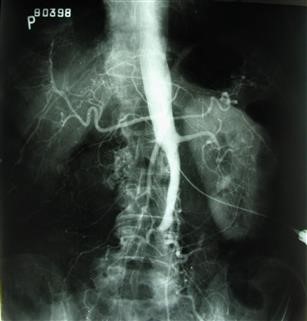 Infertility Icd 10