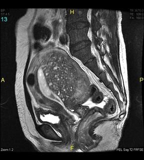Hypothyroidism Causing Infertility