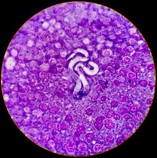 Unexplained Infertility Patients