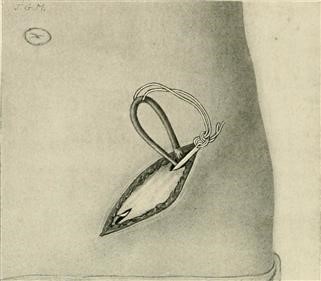 Uterus Shape and Infertility