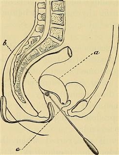 Infertility and Obesity