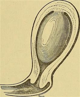 Infertility Associated Endometriosis