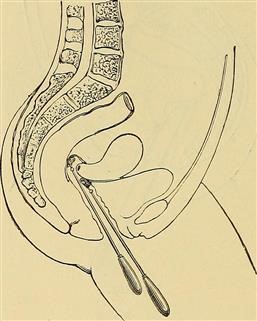 Immunological Causes of Female Infertility