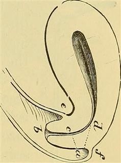Infertility in Cushing's