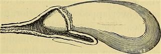 Secondary Infertility Etiology