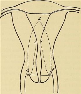 Infertility Associated Endometriosis