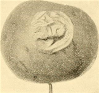 Types of Infertility Pdf