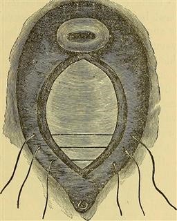 Infertility Treatment of the Underlying Condition