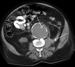 Infertility Due to Small Uterus