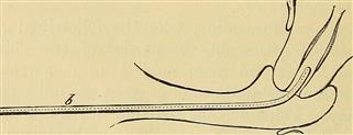 Signs Infertility After Abortion
