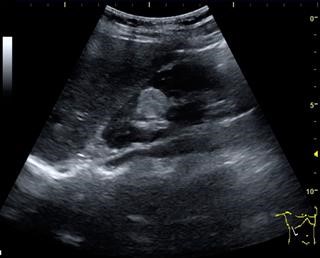 Infertility for Female