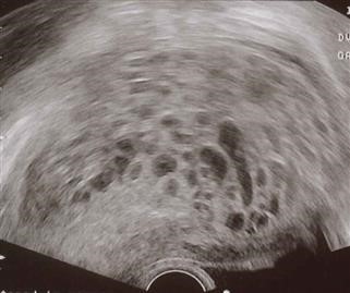 Infertility Treatment Cost in Kolkata