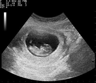 Infertility of Genetic