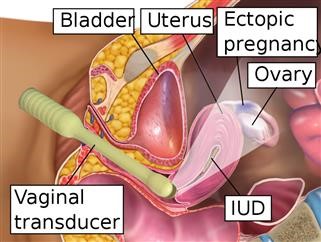 Endometriosis and Infertility Asrm