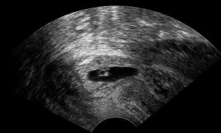 Asrm Infertility Workup