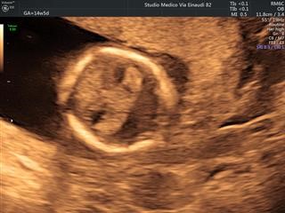 Infertility Rcog Guidelines