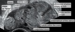 Acog Guidelines for Infertility