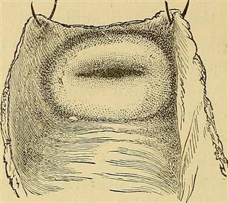 Hcg Infertility Injections
