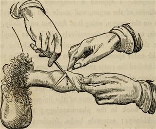Xxy Infertility